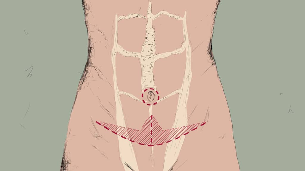 Grafik Bauchdeckenstraffung-Ankerfoermige-Schnittfuehrung