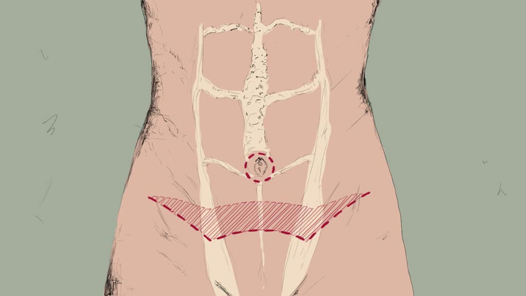 Grafik Bauchdeckenstraffung-W-foermige-Schnittfuehrung