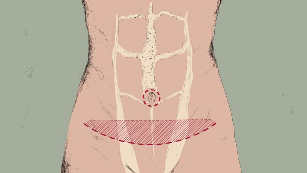 Grafik Bauchdeckenstraffung-klassische-Schnittfuehrung