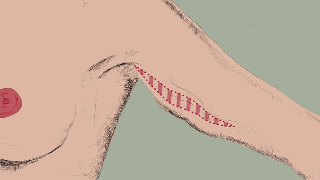 Grafik Oberarmstraffung