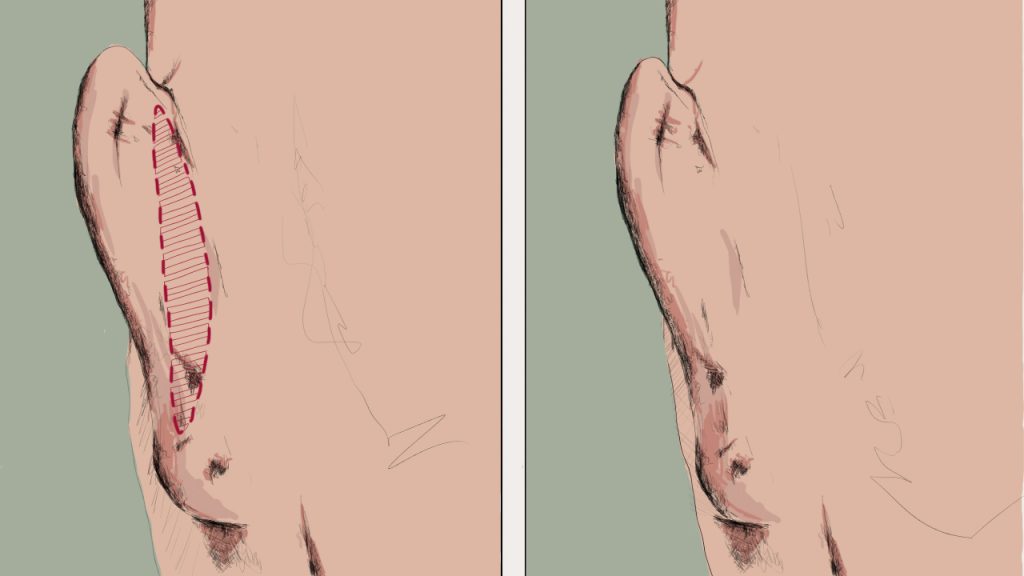 Ohrkorrektur Schema für Operationsplanung